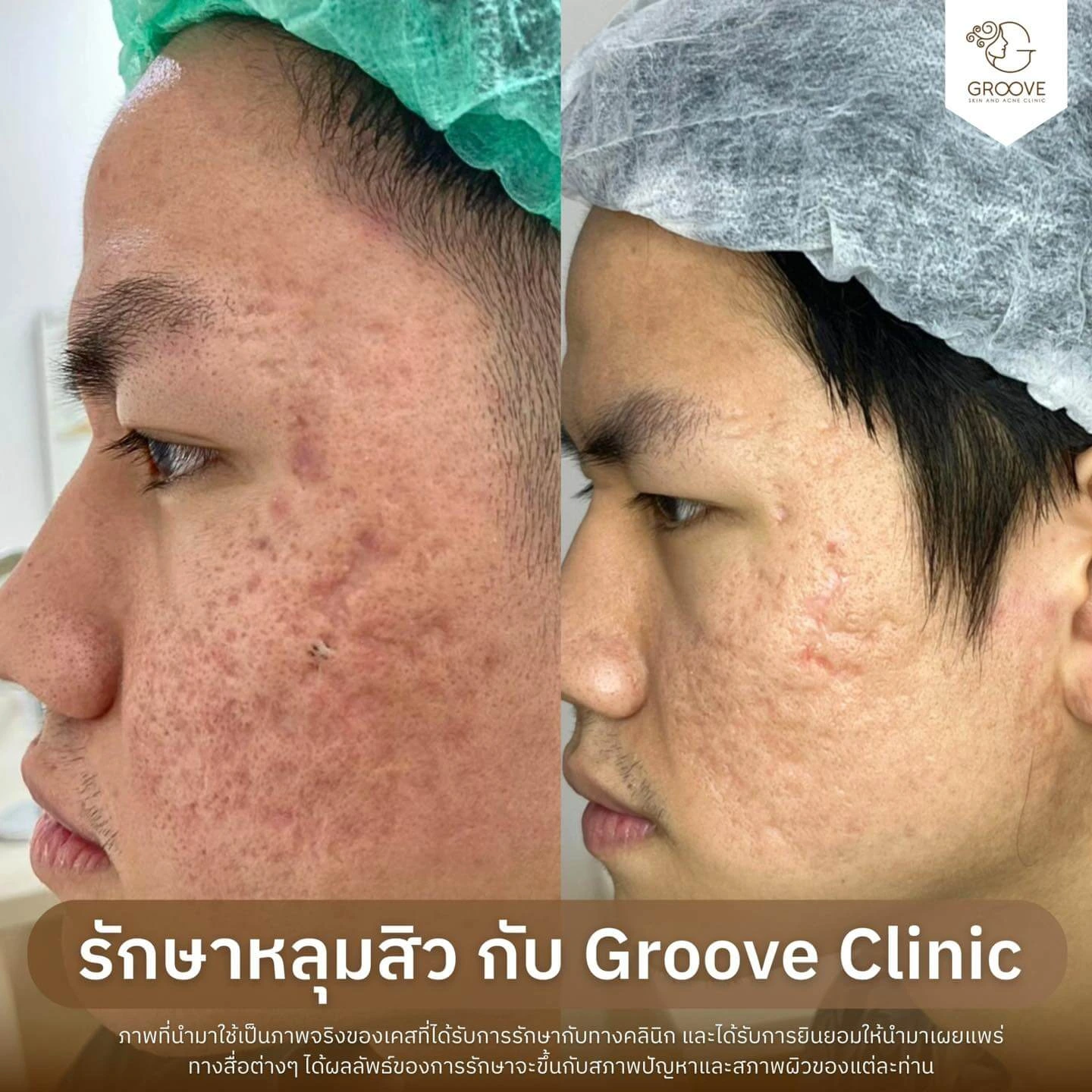 ก่อน-หลังรักษาหลุมสิว Groove Clinic