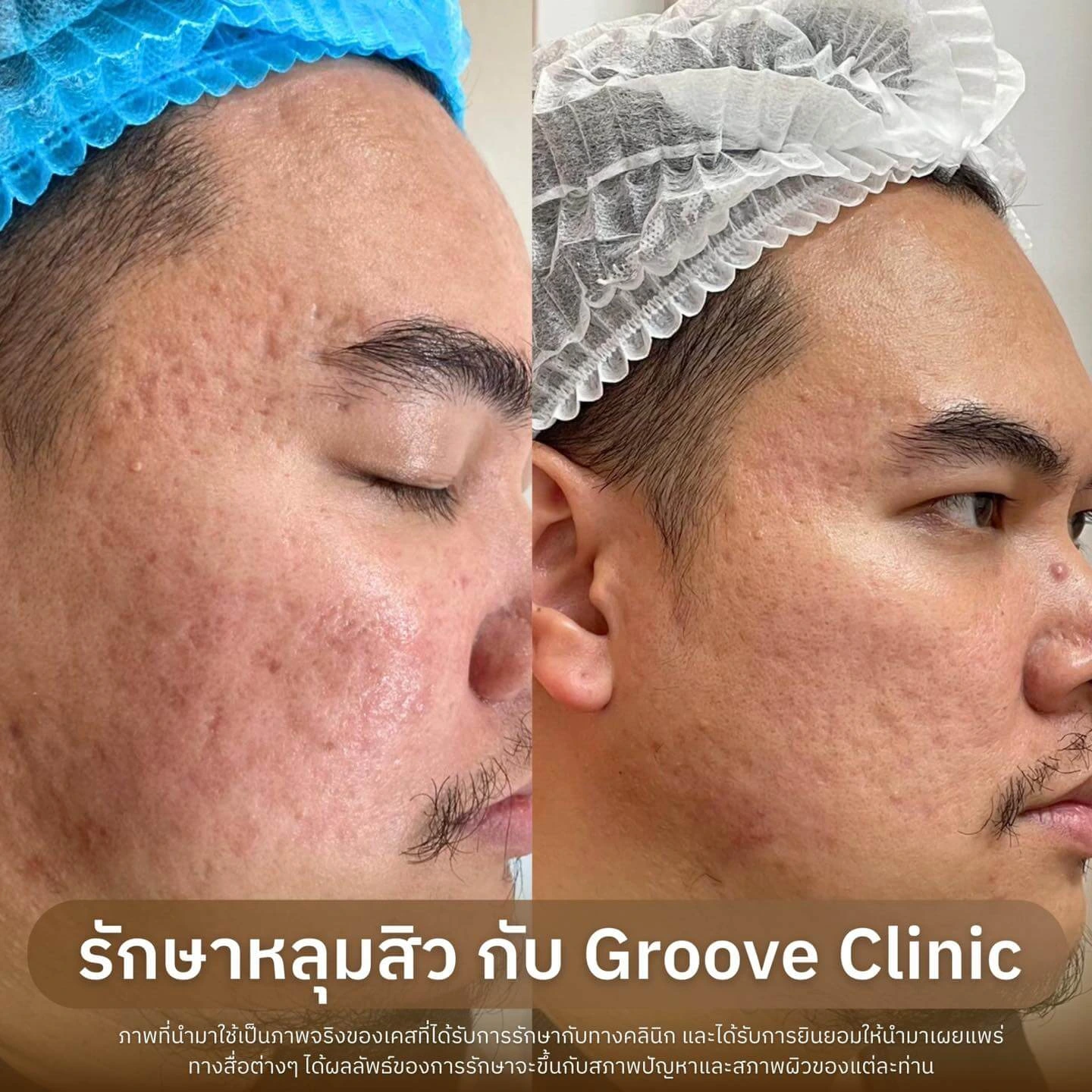 ก่อน-หลังรักษาหลุมสิว Groove Clinic