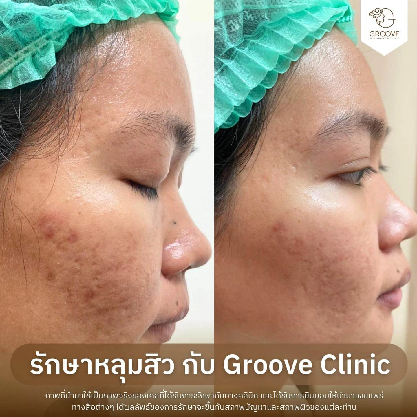 ก่อน-หลังรักษาหลุมสิว Groove Clinic