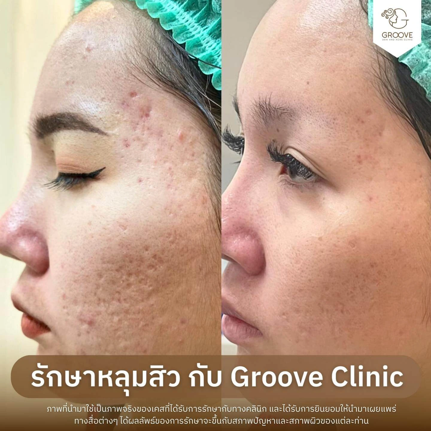ก่อน-หลังรักษาหลุมสิว Groove Clinic