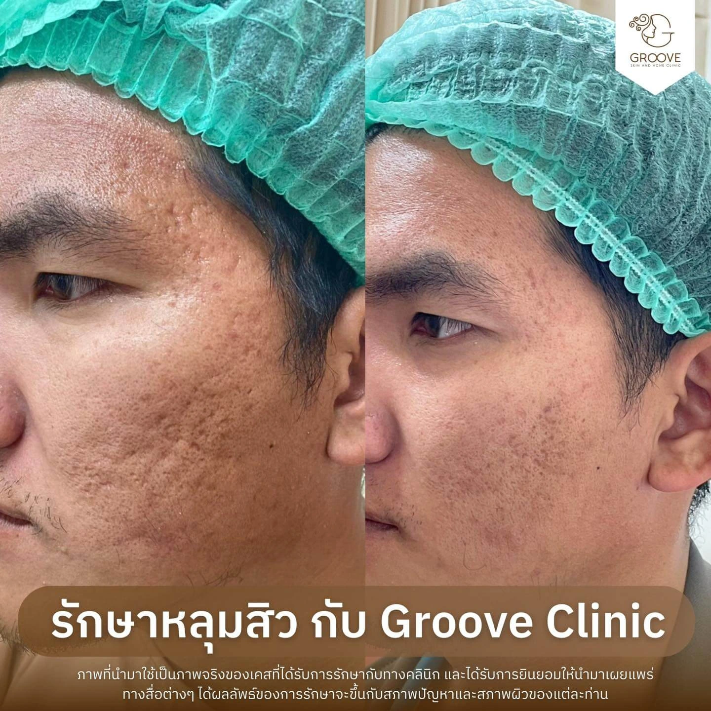 ก่อน-หลังรักษาหลุมสิว Groove Clinic