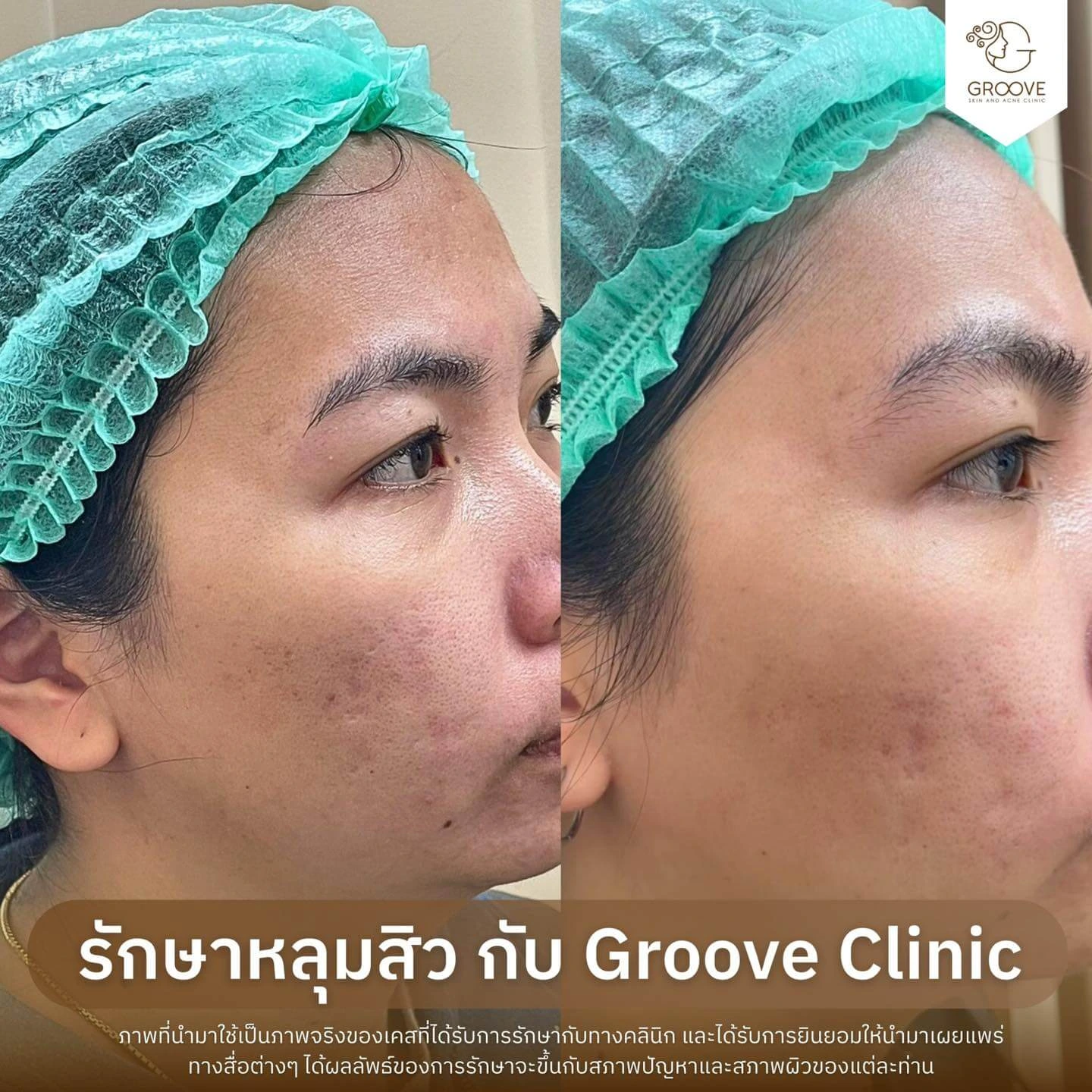 ก่อน-หลังรักษาหลุมสิว Groove Clinic