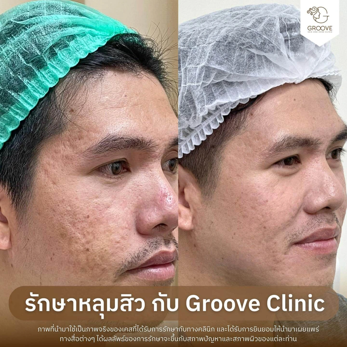 ก่อน-หลังรักษาหลุมสิว Groove Clinic