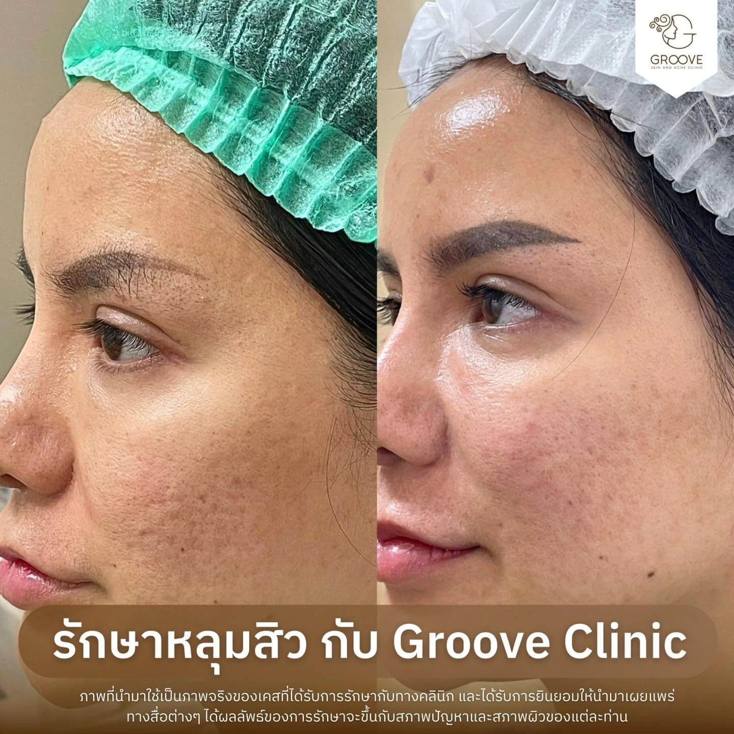ก่อน-หลังรักษาหลุมสิว Groove Clinic