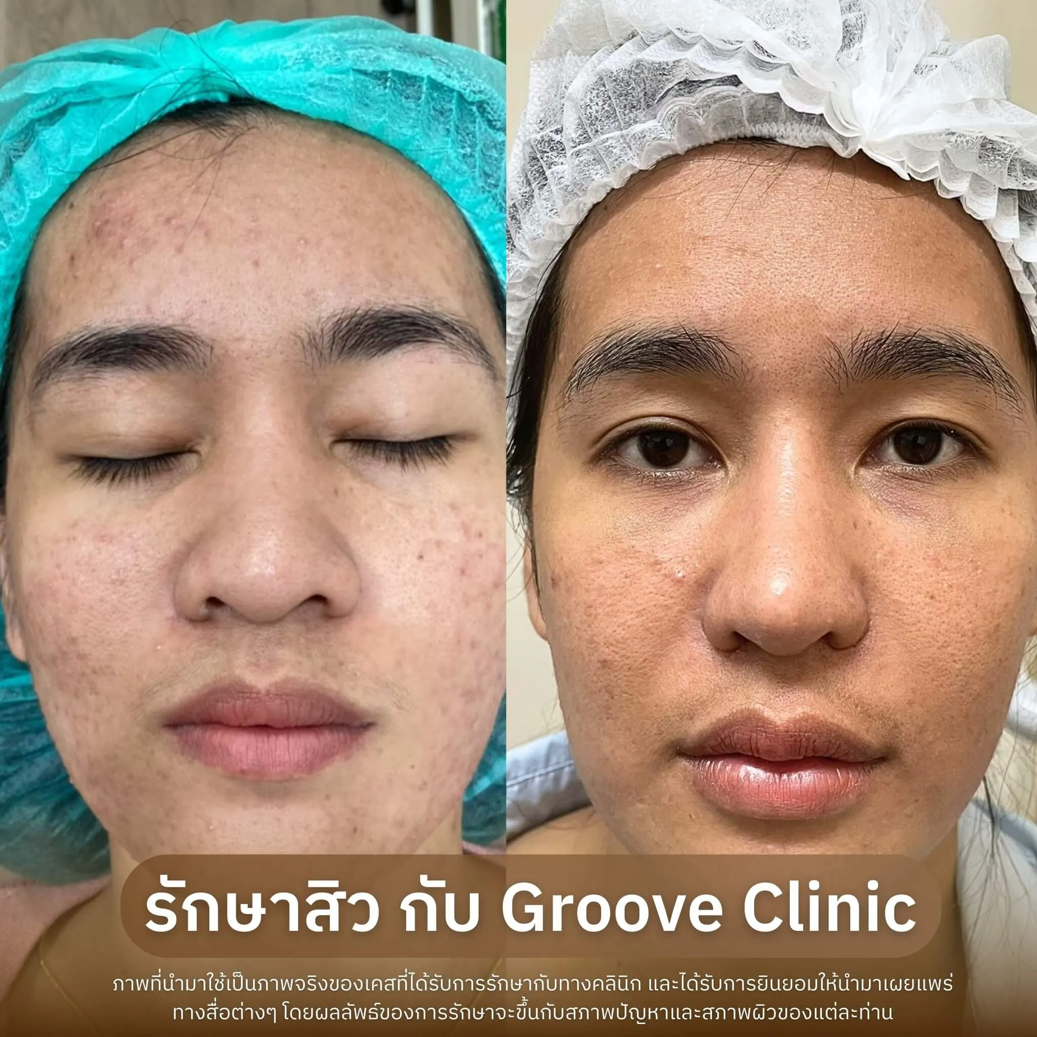 ก่อน-หลังรักษาสิว Groove Clinic