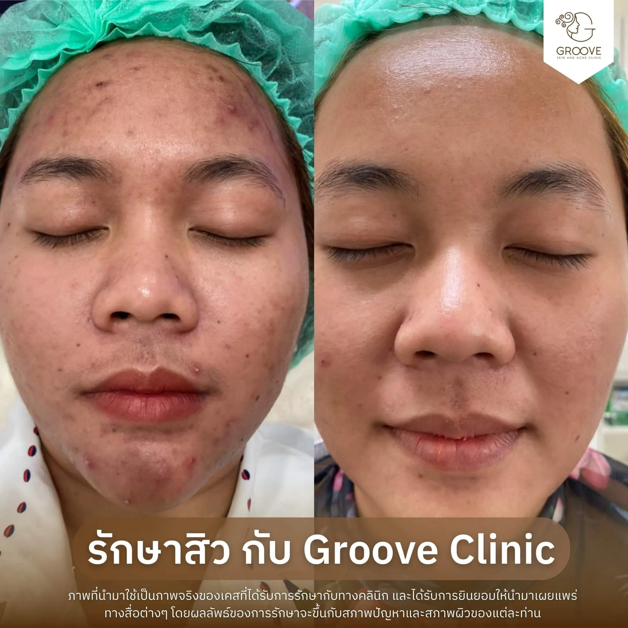 ก่อน-หลังรักษาสิว Groove Clinic