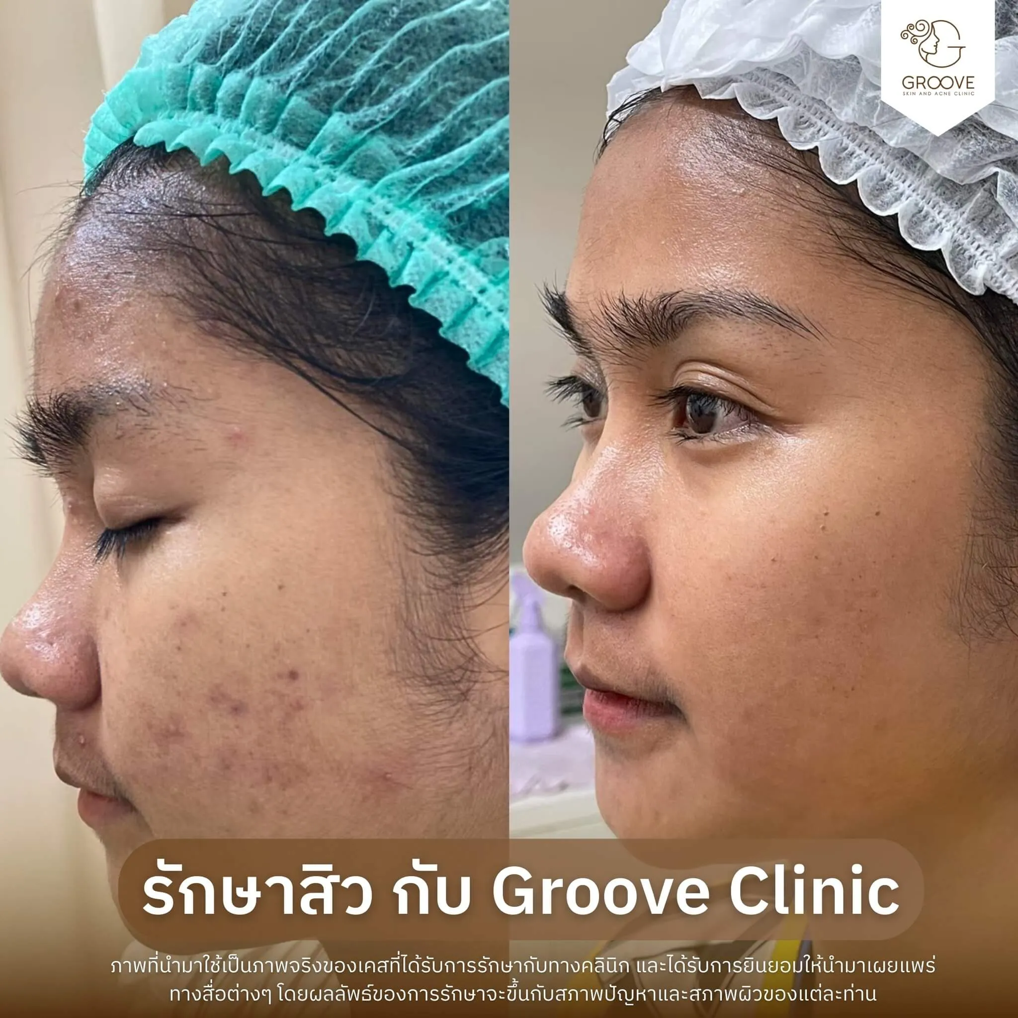 ก่อน-หลังรักษาสิว Groove Clinic