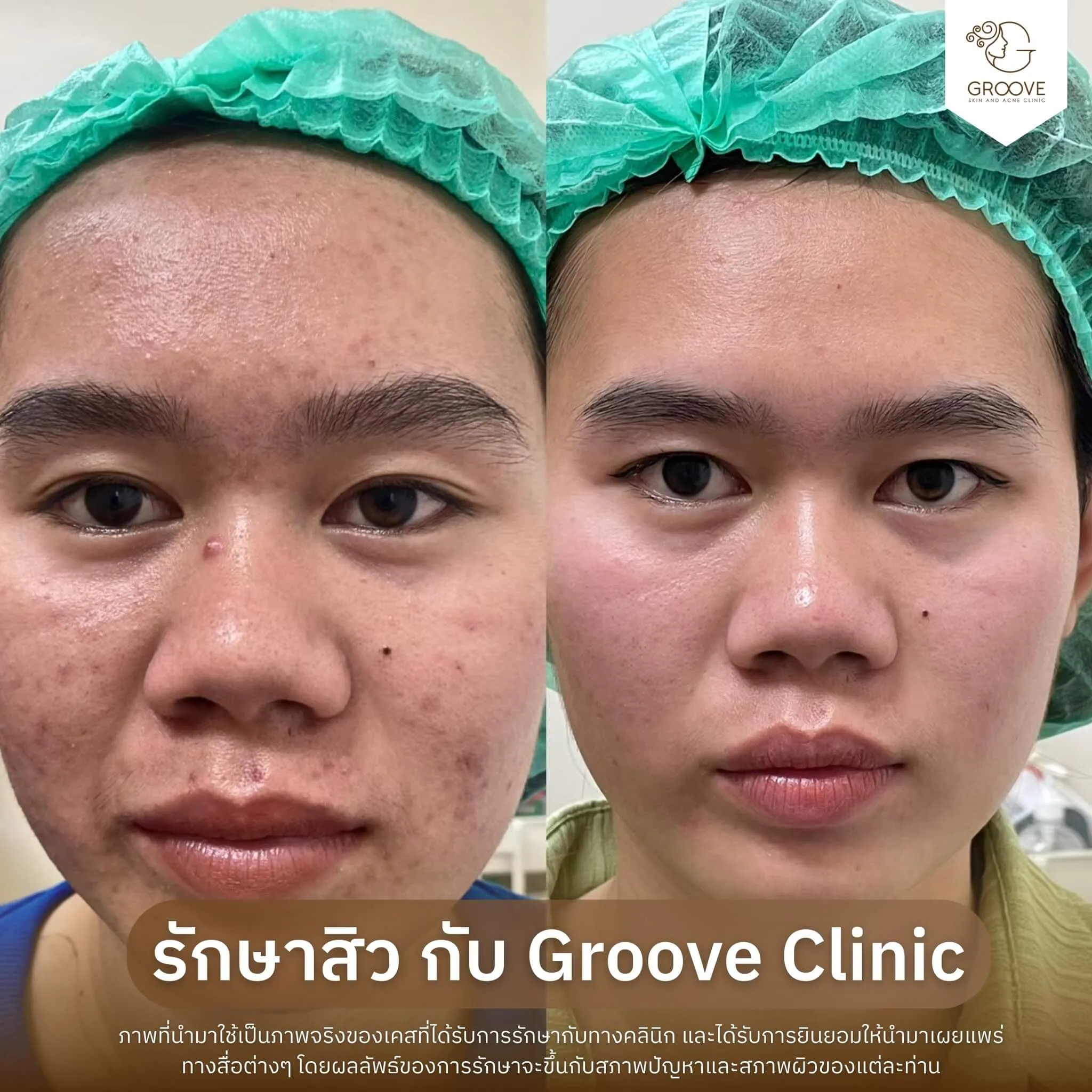 รักษาสิว เคส #9