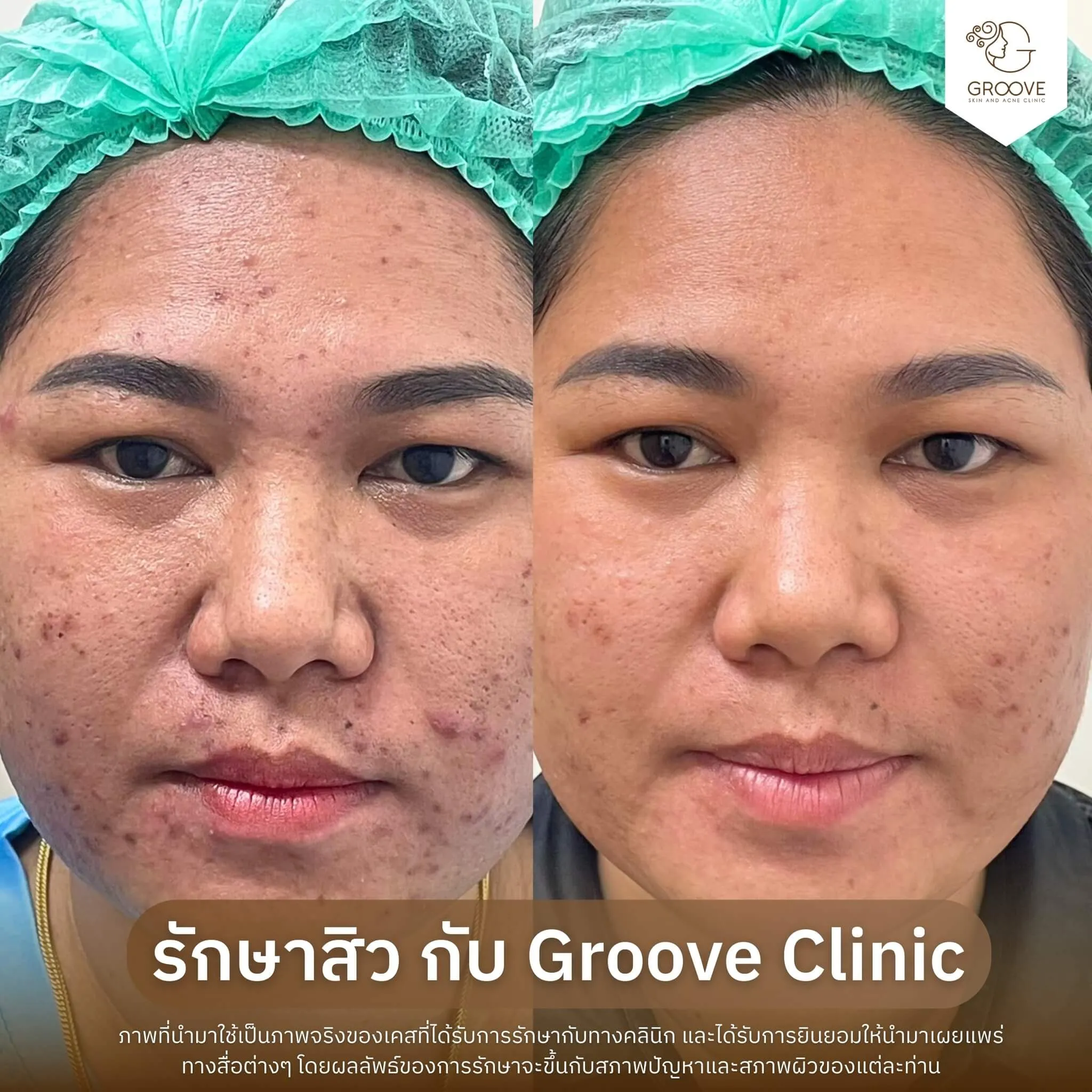 รักษาสิว เคส #10