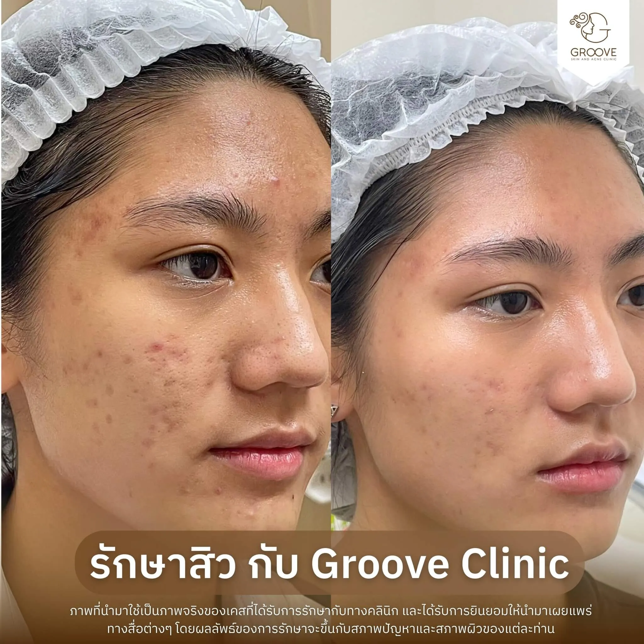 ก่อน-หลังรักษาสิว Groove Clinic