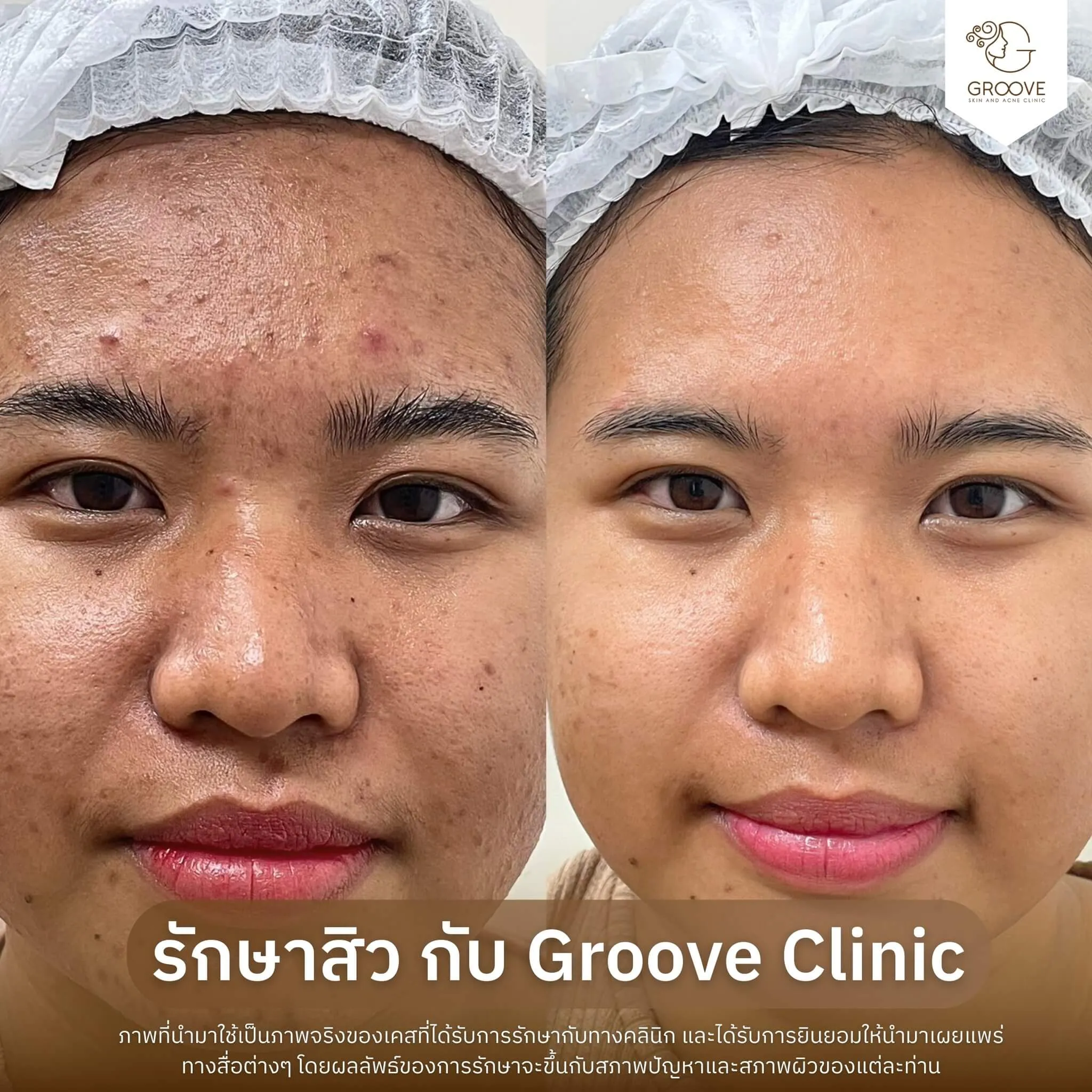 รักษาสิว เคส #11