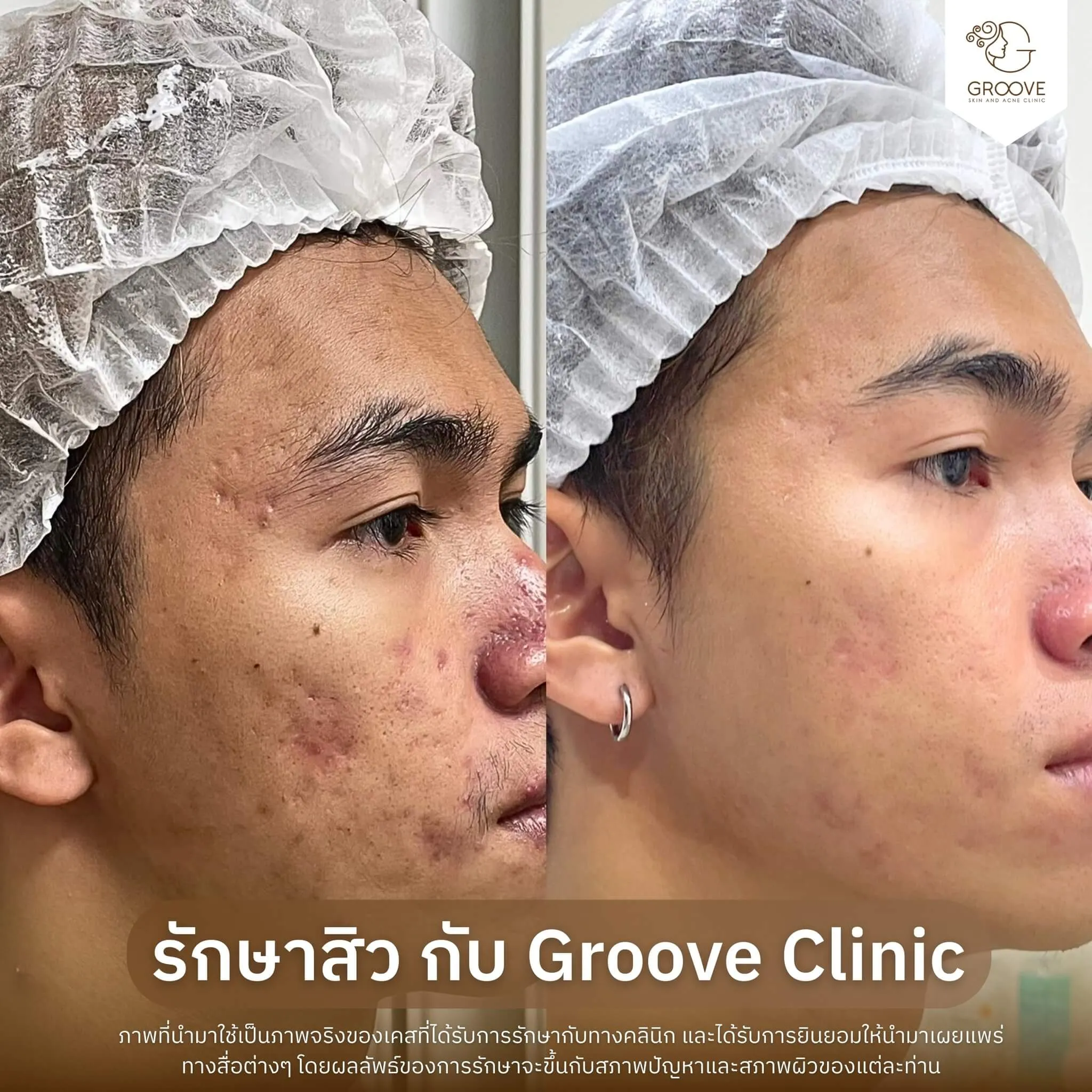 รักษาสิว เคส #12