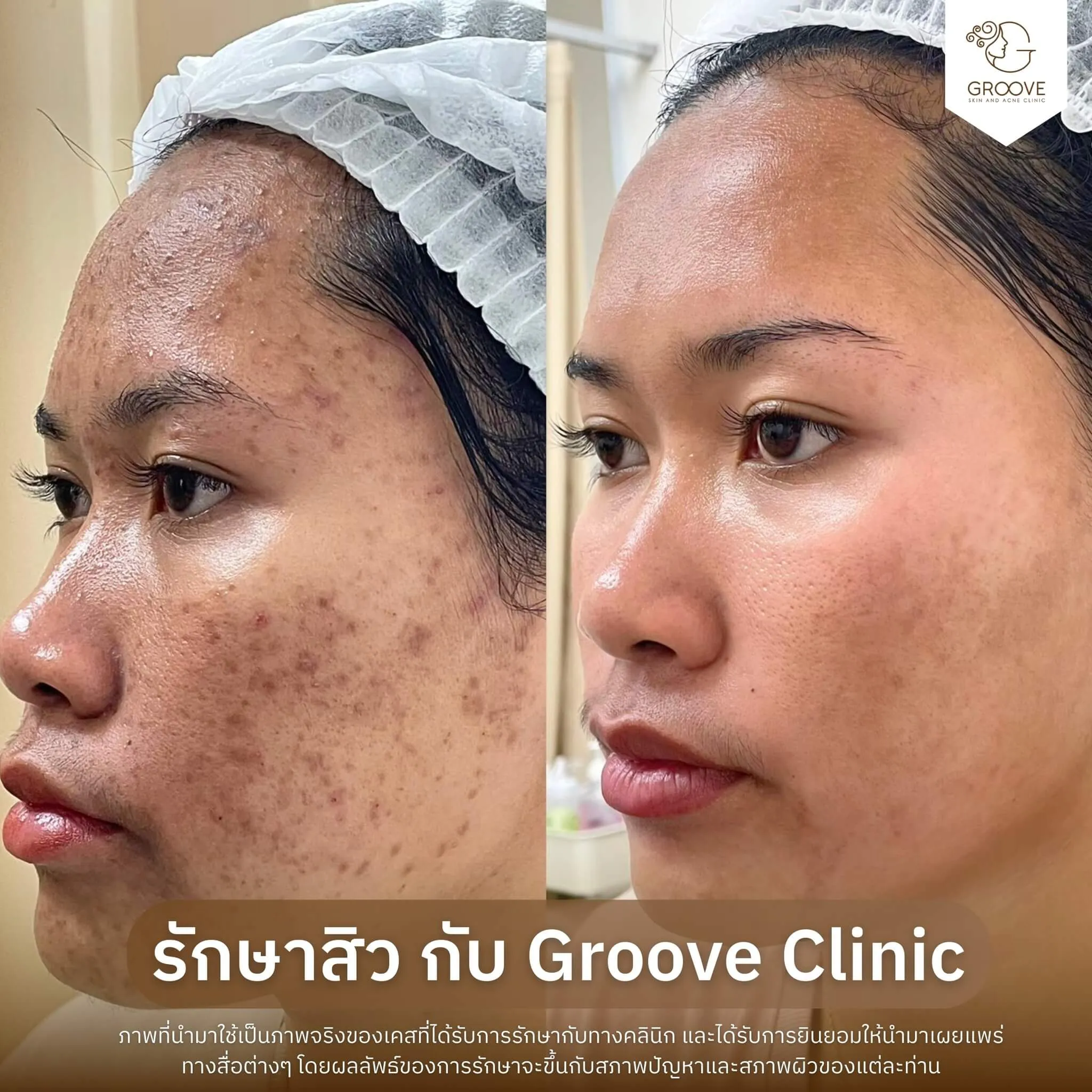 ก่อน-หลังรักษาสิว Groove Clinic