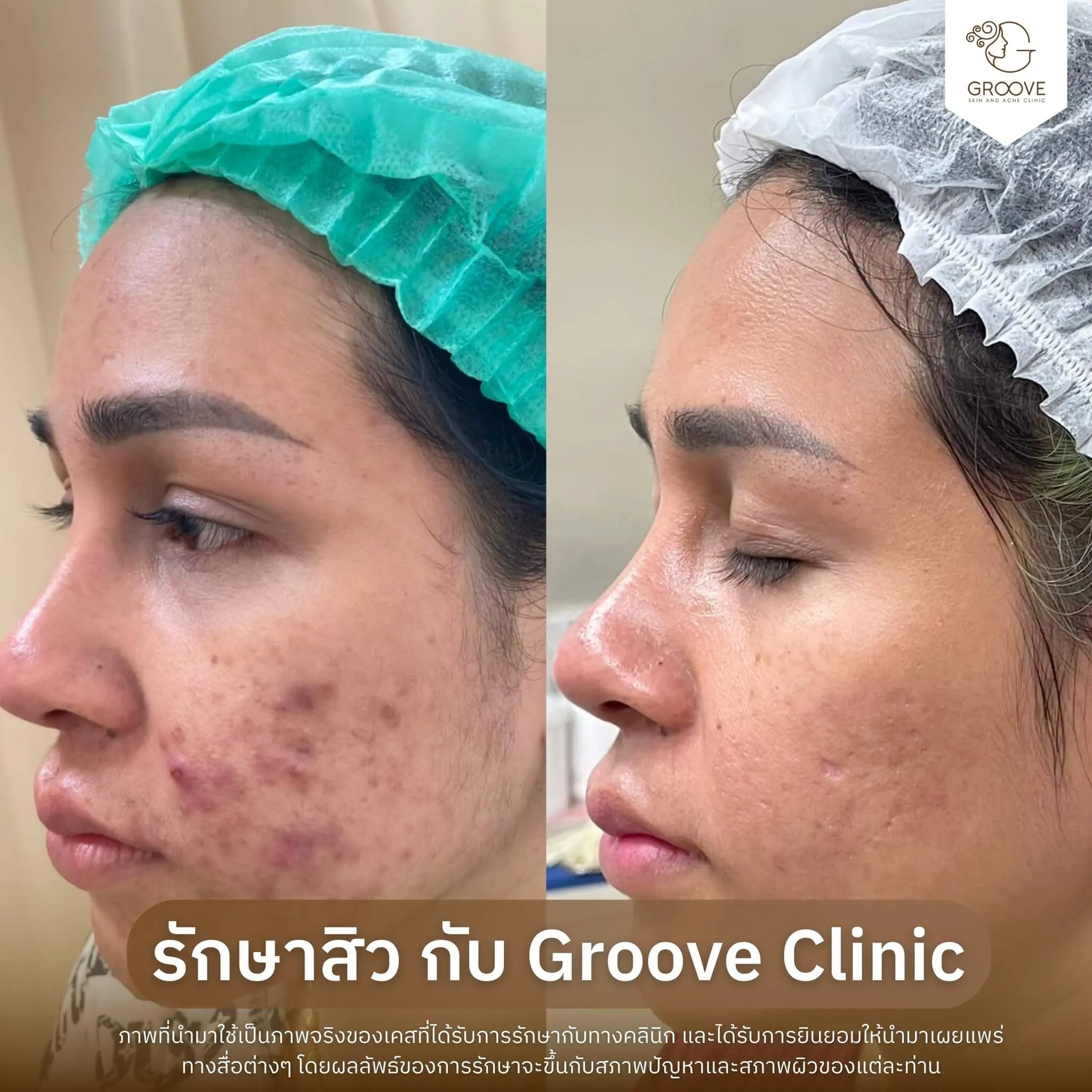 ก่อน-หลังรักษาสิว Groove Clinic