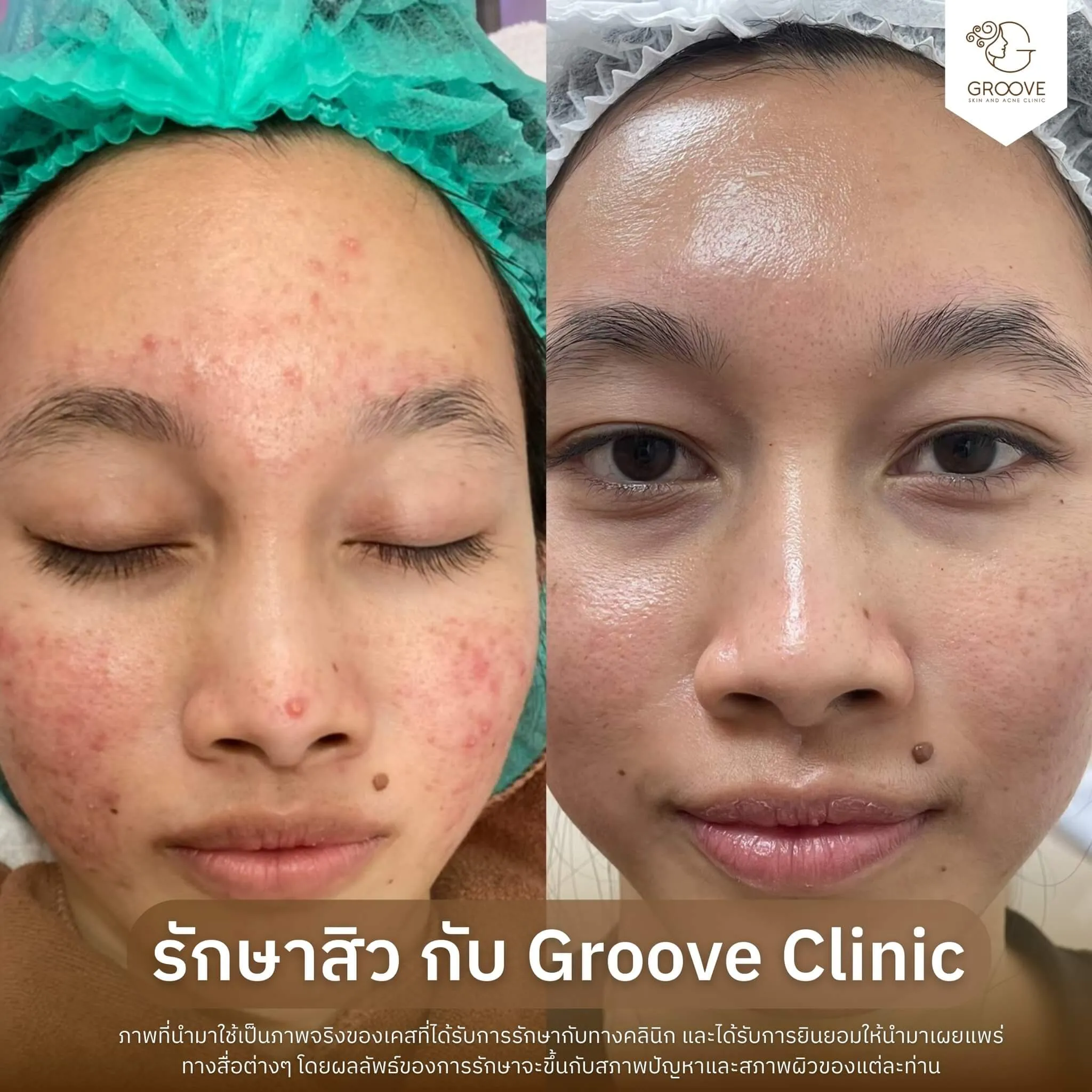 ก่อน-หลังรักษาสิว Groove Clinic