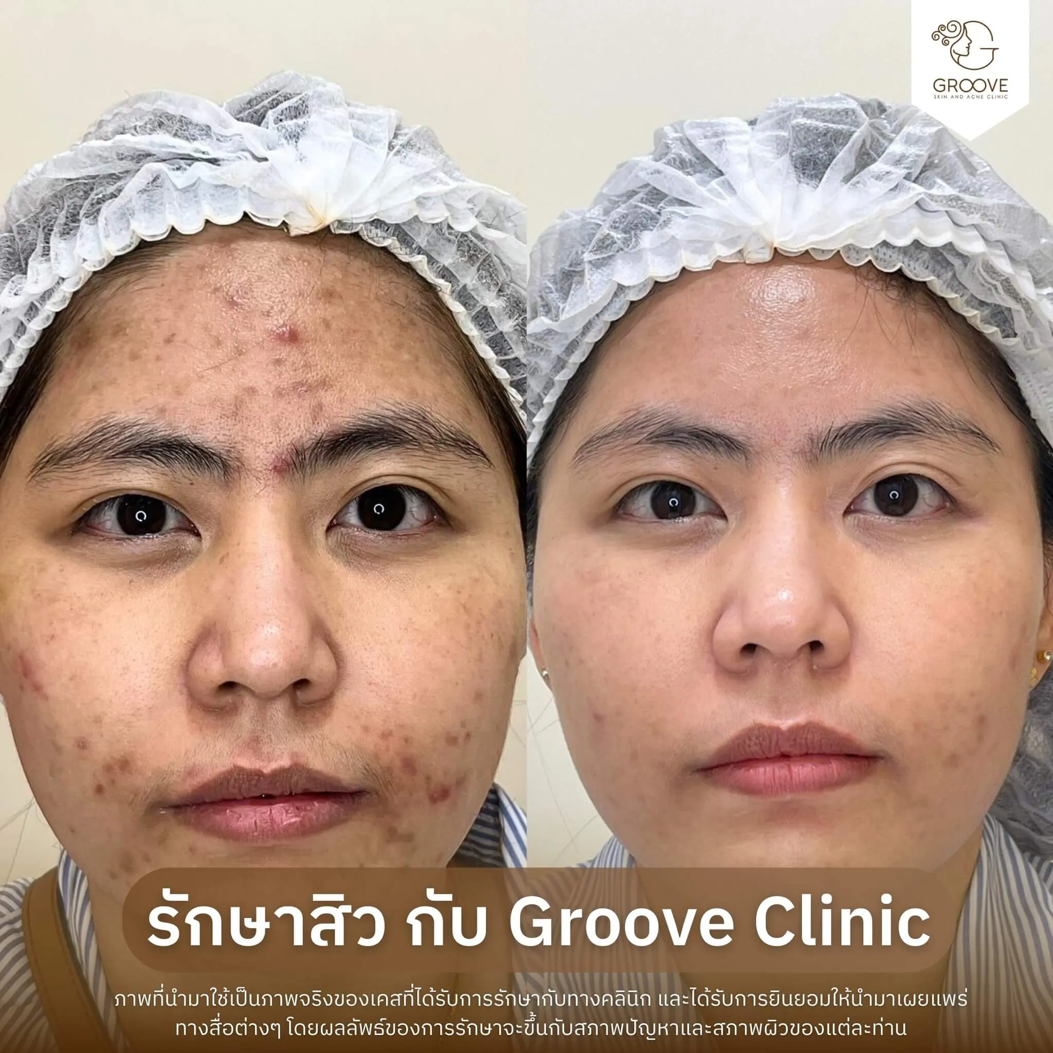 ก่อน-หลังรักษาสิว Groove Clinic