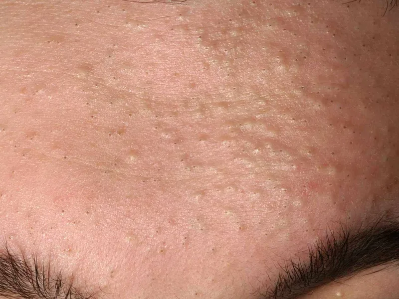 สิวหัวดำ (Black heads)