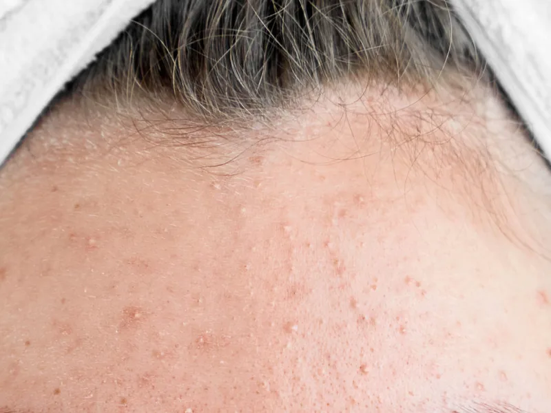 สิวผด (Acne aestivalis)