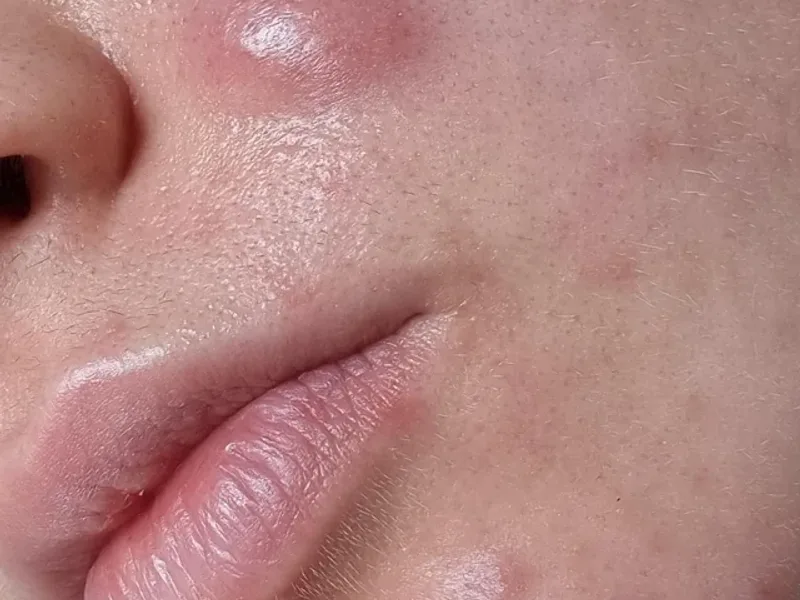 สิวอักเสบขนาดใหญ่ (Nodules)