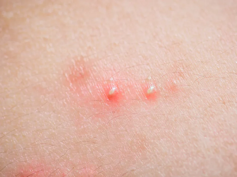 สิวหัวหนอง (Pustules)