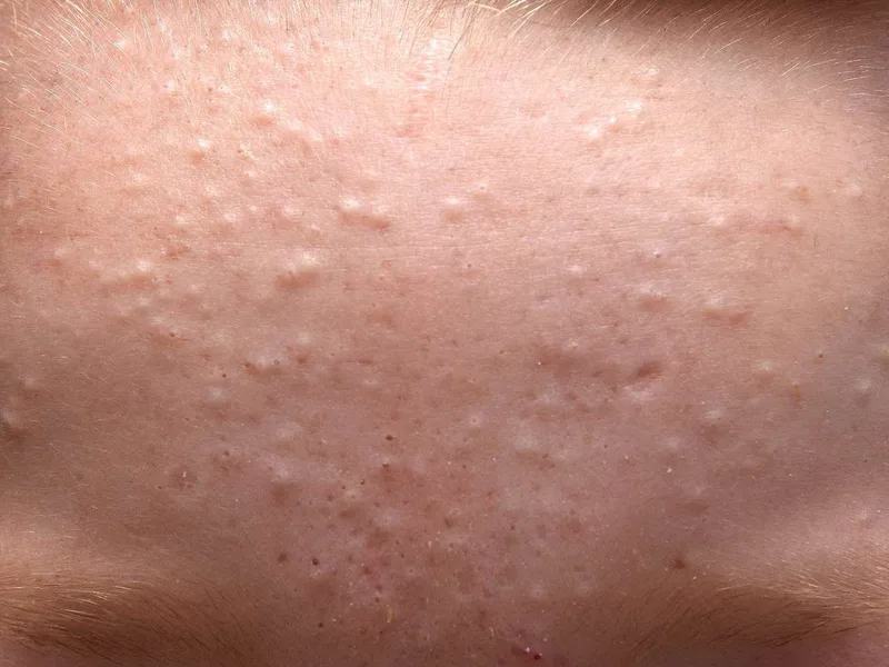 สิวหัวขาว (White heads)
